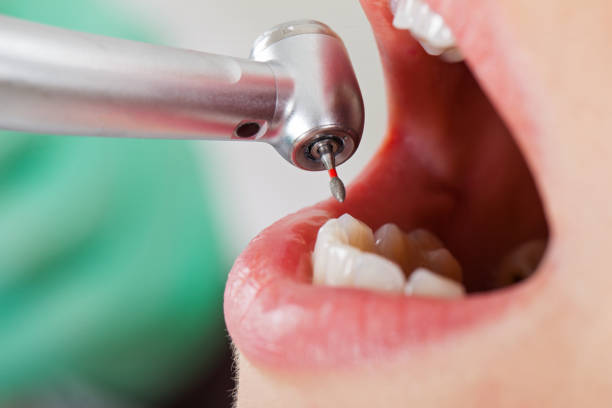 Best Emergency Dentist for Lost Fillings or Crowns in Encantada Ranchito El Calaboz, TX